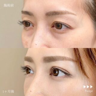 切らない目の下のクマ取り・目の下のたるみ（ふくらみ）取り