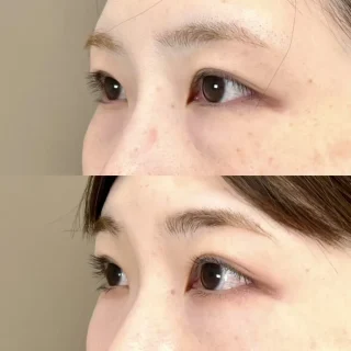 切らない目の下のクマ取り・目の下のたるみ（ふくらみ）取り