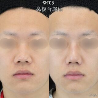 小鼻・鼻の穴を小さくする施術（小鼻縮小術・鼻孔縁挙上）