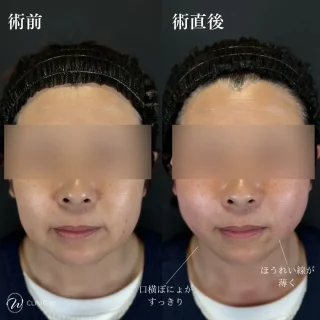 糸リフト(W式リフト)