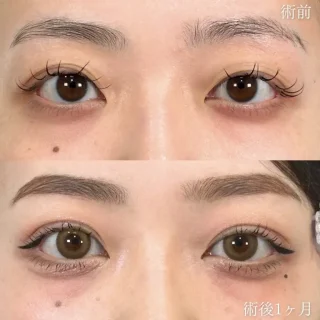 二重埋没法