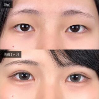 二重埋没法