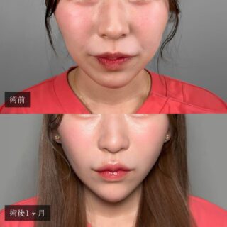 小顔美肌再生（リフトアップ）