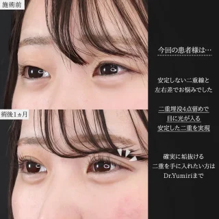 埋没4点留め
