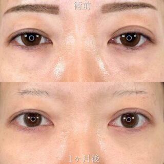 切らない目の下のクマ取り・目の下のたるみ（ふくらみ）取り＆目の下のヒアルロン酸注射＆クマ取り再生注射