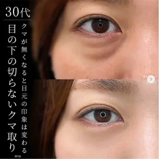目の下のクマ取り・たるみ取り