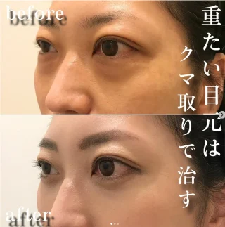 切らない目の下のクマ取り