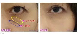 目の下のふくらみ取り