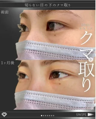切らない⽬の下のクマ取り・たるみ取り