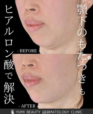 ヒアルロン酸