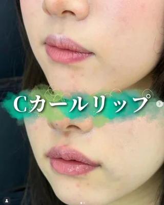 Cカールリップ