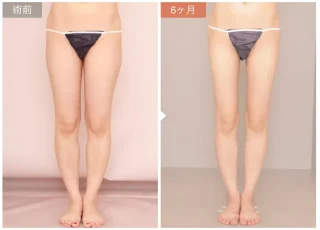 太もも全周＋お尻の脂肪吸引