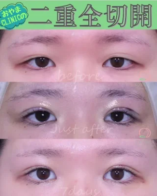 二重全切開