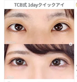 TCB式1dayクイックアイ