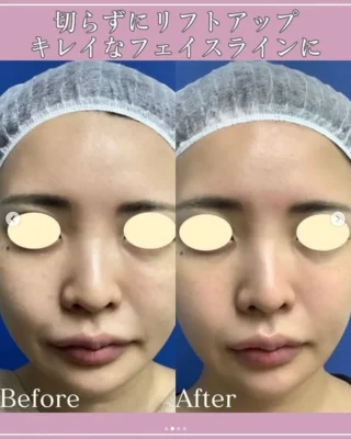 HIFU(ハイフ)