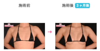 Aquicell（アキーセル）併用コンデンスリッチ(脂肪注入豊胸)