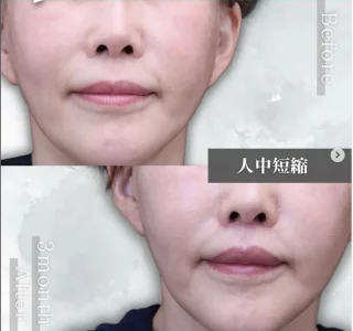 人中短縮術