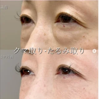 切らない⽬の下のクマ取り・たるみ取り