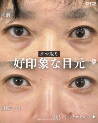 切らない目の下のクマ取り