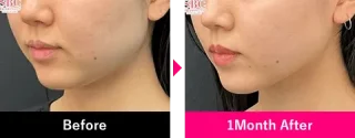 小顔用脂肪吸引注射