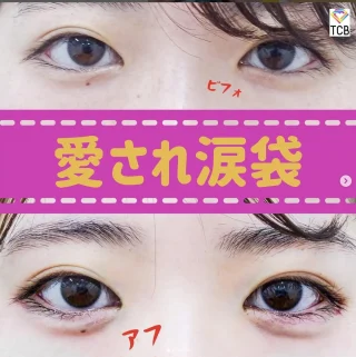 涙袋ヒアルロン酸