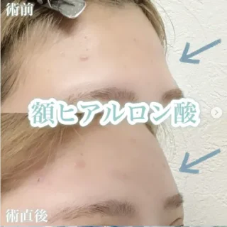 ヒアルロン酸注射