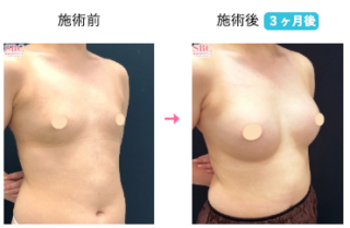 Motivaエルゴノミックス2(バッグ豊胸)