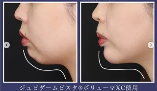 アゴのヒアルロン酸