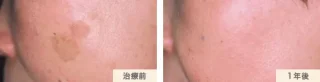 Qレーザースポット