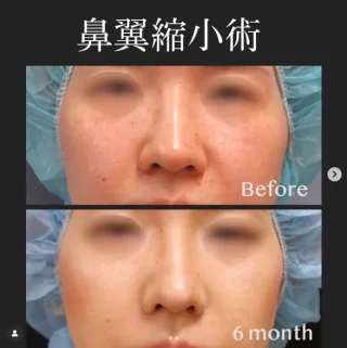 鼻翼縮小術(内・外側法)