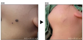 ほくろ除去+切除