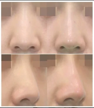 クレヴィエル・コントア（鼻・アゴ専用ヒアルロン酸）