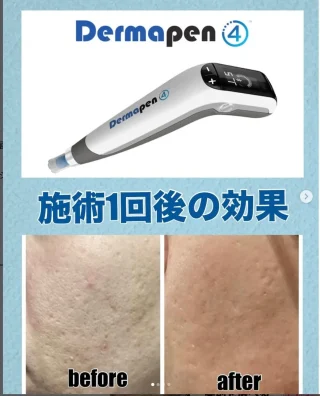 ダーマペン(成長因子)