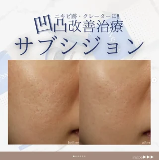 サブシジョン