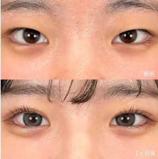 二重埋没法
