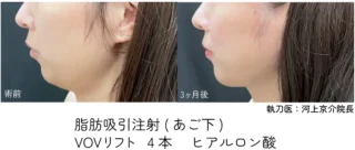 脂肪吸引注射