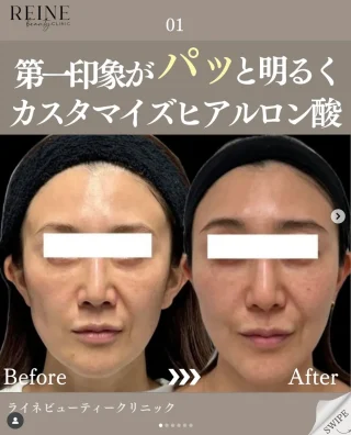 ヒアルロン酸注射
