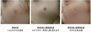左頬のシミ Qスイッチルビーレーザー治療