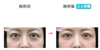 切開ハムラ(表ハムラ)法