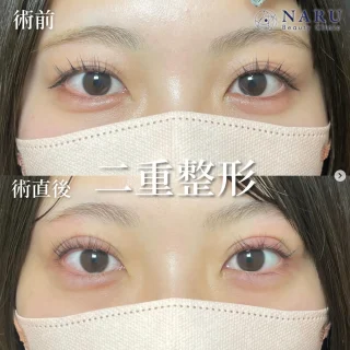 二重埋没法
