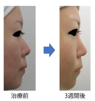 プロテーゼ法隆鼻術