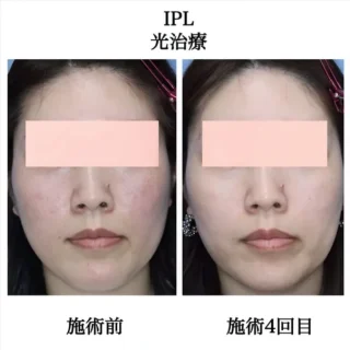 IPL光治療