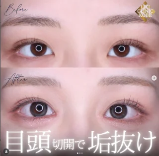 目頭切開