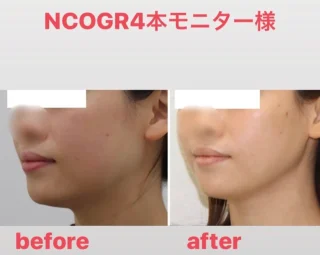 糸リフト