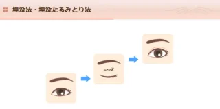 さくら美容外科クリニック 埋没法・埋没たるみとり法の施術メニュー画像
