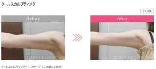 クールスカルプティング