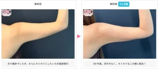 美ボディ脂肪吸引