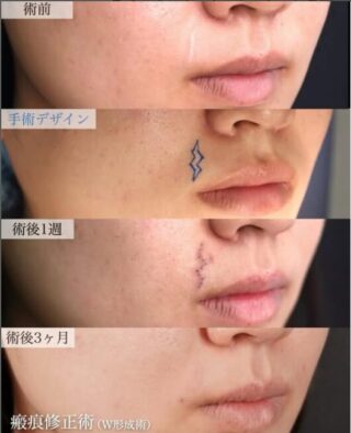 瘢痕修正術(W形成術)