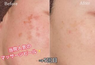 コラーゲンマッサージピール