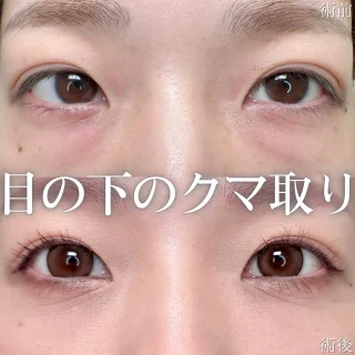 クマ取り